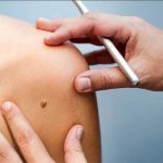 Skin Tag Removal Cost