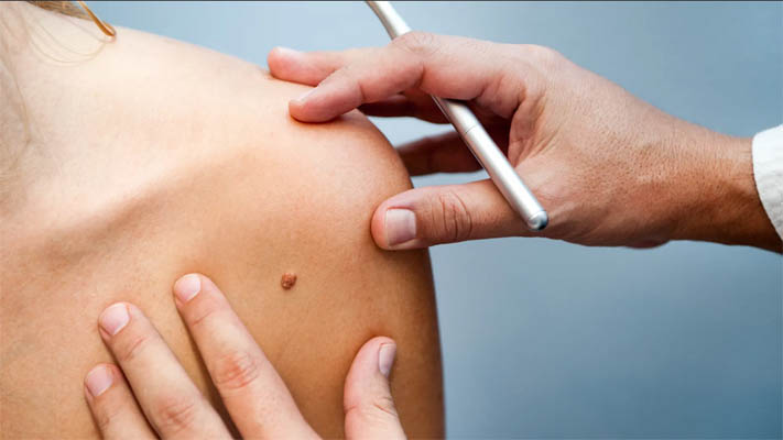 Skin Tag Removal Cost